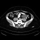 Mesentric cyst, mesothelial cyst: CT - Computed tomography